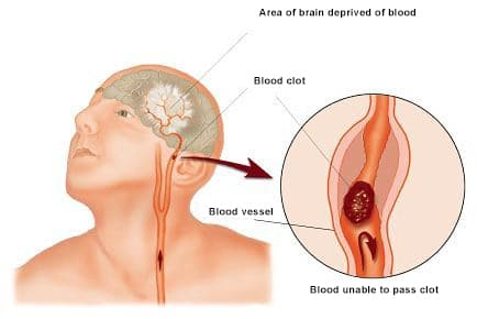 <p>infarct </p>