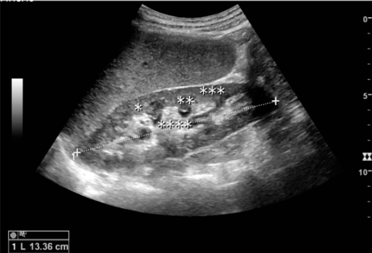 <p>You are measuring right kidney as you prepare to complete the renal artery Doppler. Convert measurement to millimeters. Select best answer</p>