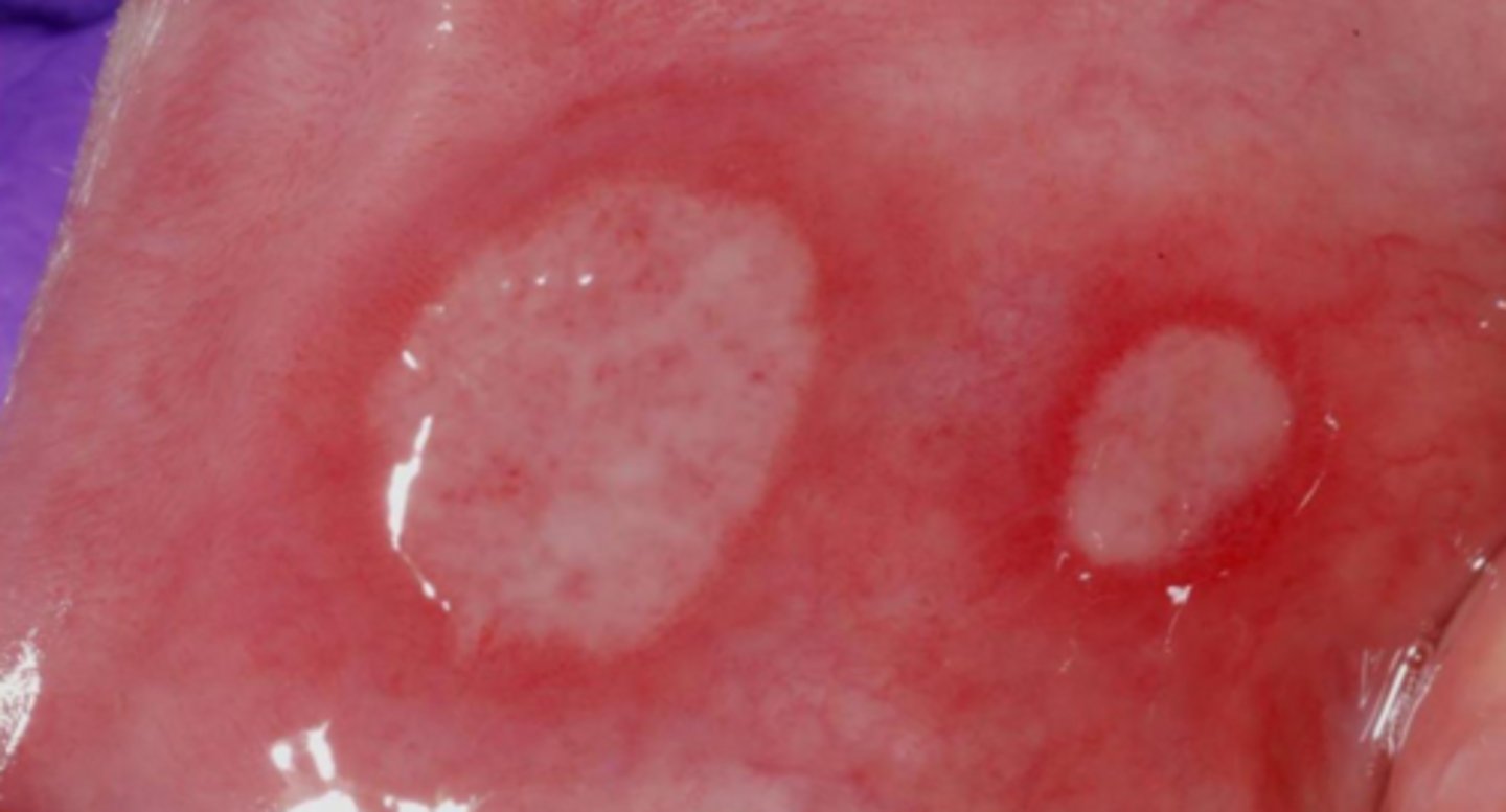 <p>ulcers</p>