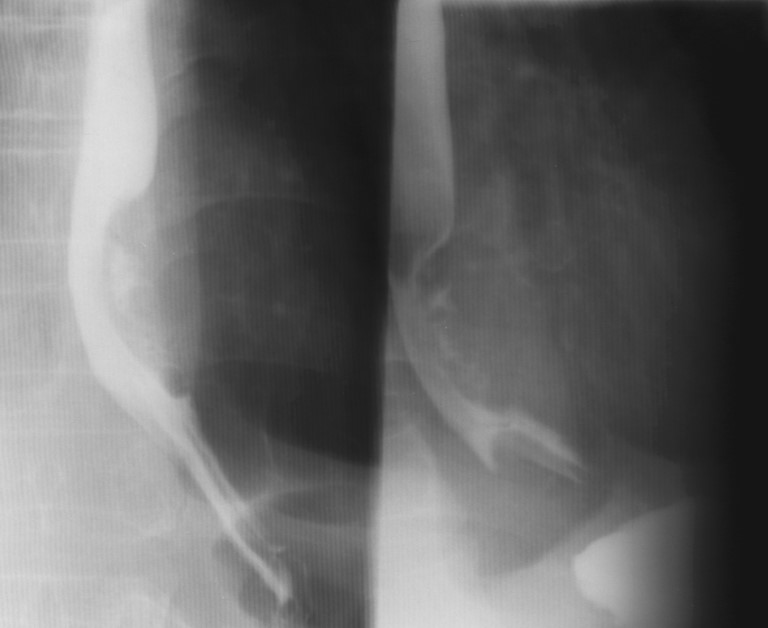 <p>What is the radiographic appearance of the infiltrating type of esophageal carcinoma?</p>