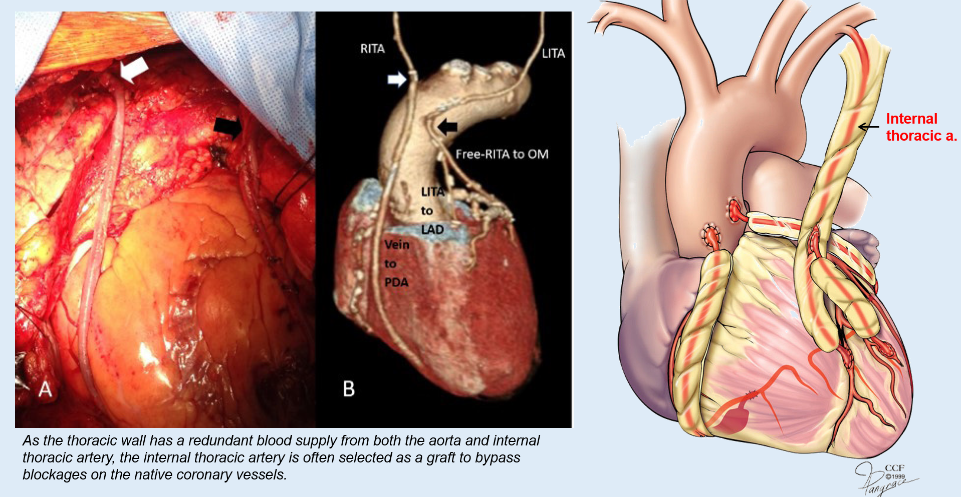 <p>A surgical procedure that <strong>bypasses blocked coronary arteries</strong> using a <strong>graft</strong> (usually from the <strong>internal thoracic artery</strong> or a <strong>vein</strong>)</p>