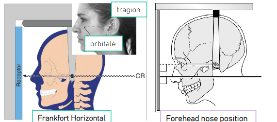 <ul><li><p>pt facing receptor </p></li><li><p>mid-sagittal plane vertical, perpendicular to receptor </p></li><li><p>Frankfort plane horizontal, perpendicular to the receptor or forehead-nose position </p></li><li><p>maximum intercuspation </p></li></ul><p></p>
