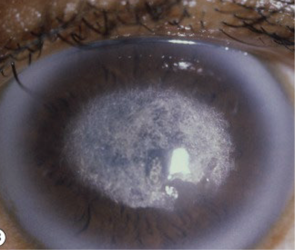 <ul><li><p>autosomal dominant</p></li><li><p><span><strong>Onset</strong>: first decade with diagnosis coming in the second to third decade</span></p></li><li><p><span><strong>Symptoms</strong>: glare and significant vision loss/change in 6th decade</span></p></li><li><p><span><strong>Presentation</strong>: deposits are made up of lipid</span></p><ul><li><p><span>Ring like opacity or central comma-shaped crystals</span></p><ul><li><p><span>Subepithelial crystalline deposits and elevated blood lipid levels are seen in 50% of pts</span></p></li></ul></li><li><p><span>Central corneal haze</span></p></li><li><p><span>Prominent arcus senilis (gradually moves central and causes haze)</span></p></li><li><p><span>Reduced corneal sensitivity</span></p></li></ul></li><li><p><span><strong>Treatment</strong>: phototherapeutic keratectomy and penetrating keratoplasty</span></p></li></ul><p></p>