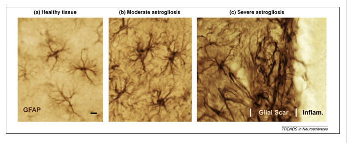 <ul><li><p>caused by injuries in the CNS</p></li><li><p>astrocytes wall off injury site</p></li><li><p>limit spread of inflammation</p></li><li><p>limit regeneration of axons on injured neurons</p></li></ul><p></p>