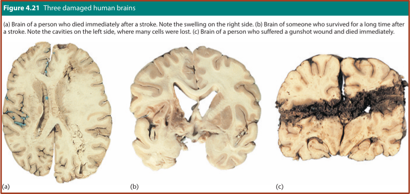 <ol><li><p>Person who <strong>died immediately after a stroke</strong>.</p></li><li><p>Person who <strong>survived a long time after a stroke</strong>.</p></li><li><p>Person who suffered a <strong>gunshot wound and died immediately</strong>.</p></li></ol><p></p>