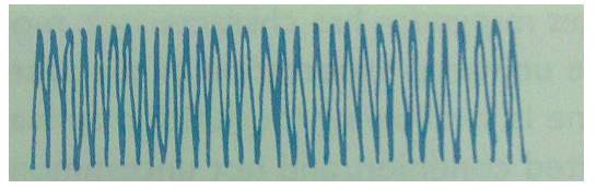 <p>Kussmaul breathing</p><p><em>Kussmaul breathing normally proceeds a medical condition while hyperventilation does not.</em></p>