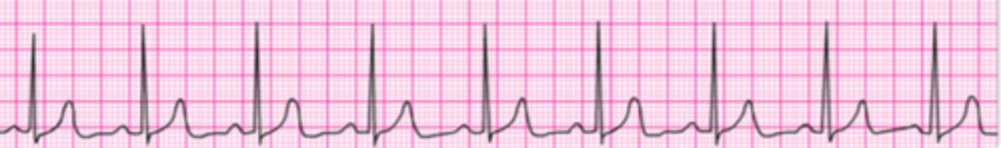 <p>You are the code team leader and arrive to find a patient with above rhythm and CPR in progress. Team members report that the patient was well but reported chest pain and then collapsed. She has no pulse or respirations. Bag-mask ventilations are producing visible chest rise, high-quality CPR is in progress, and an IV has been established. What would be your next order?</p><p>1. Administer atropine 1 mg.</p><p>2. Perform endotracheal intubation.</p><p>3. Start dopamine at 10 to 20 mcg/kg per minute.</p><p>4. Administer epinephrine 1 mg.</p><p>5. Administer amiodarone 300 mg.</p>