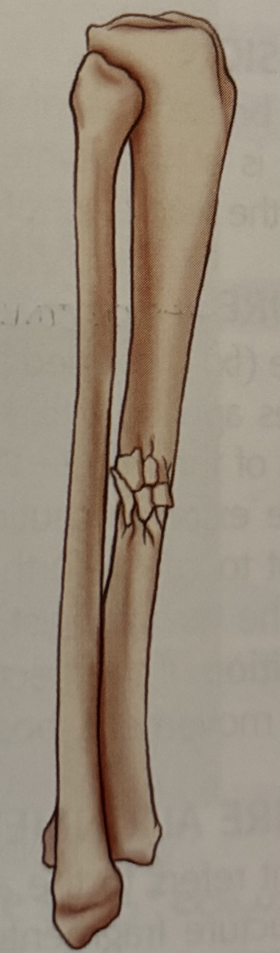 <p>What type of fracture is this?</p>