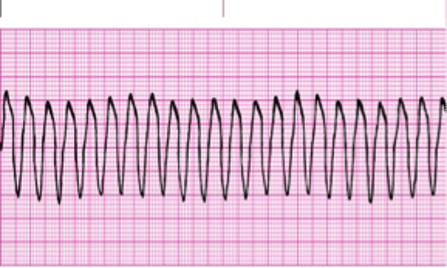 <p>Ventricular Tachycardia (VT)</p>