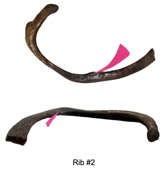 <p>Name the pointed rough surface of Rib 2:</p><p>A. Scalene Tubercle</p><p>B. Tuberosity for Serratus Anterior</p><p>C. Costal Groove</p><p>D. Costal Cup</p><p>E. Costal Facet</p>