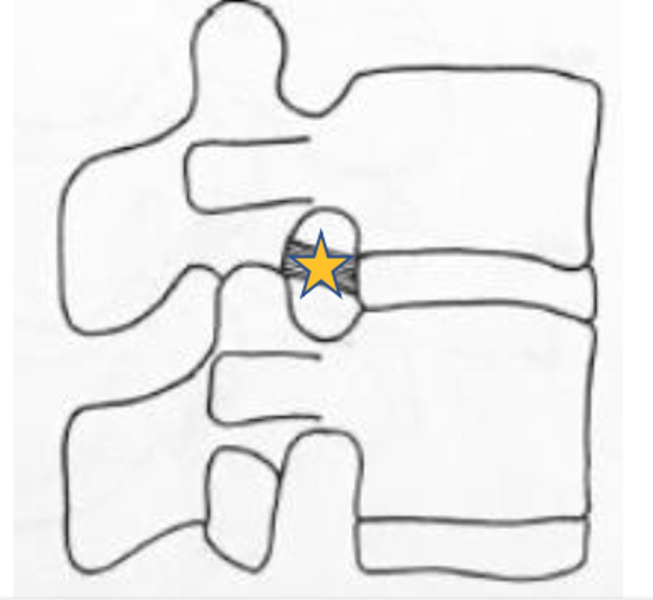 <p>Middle transforaminal ligaments</p>