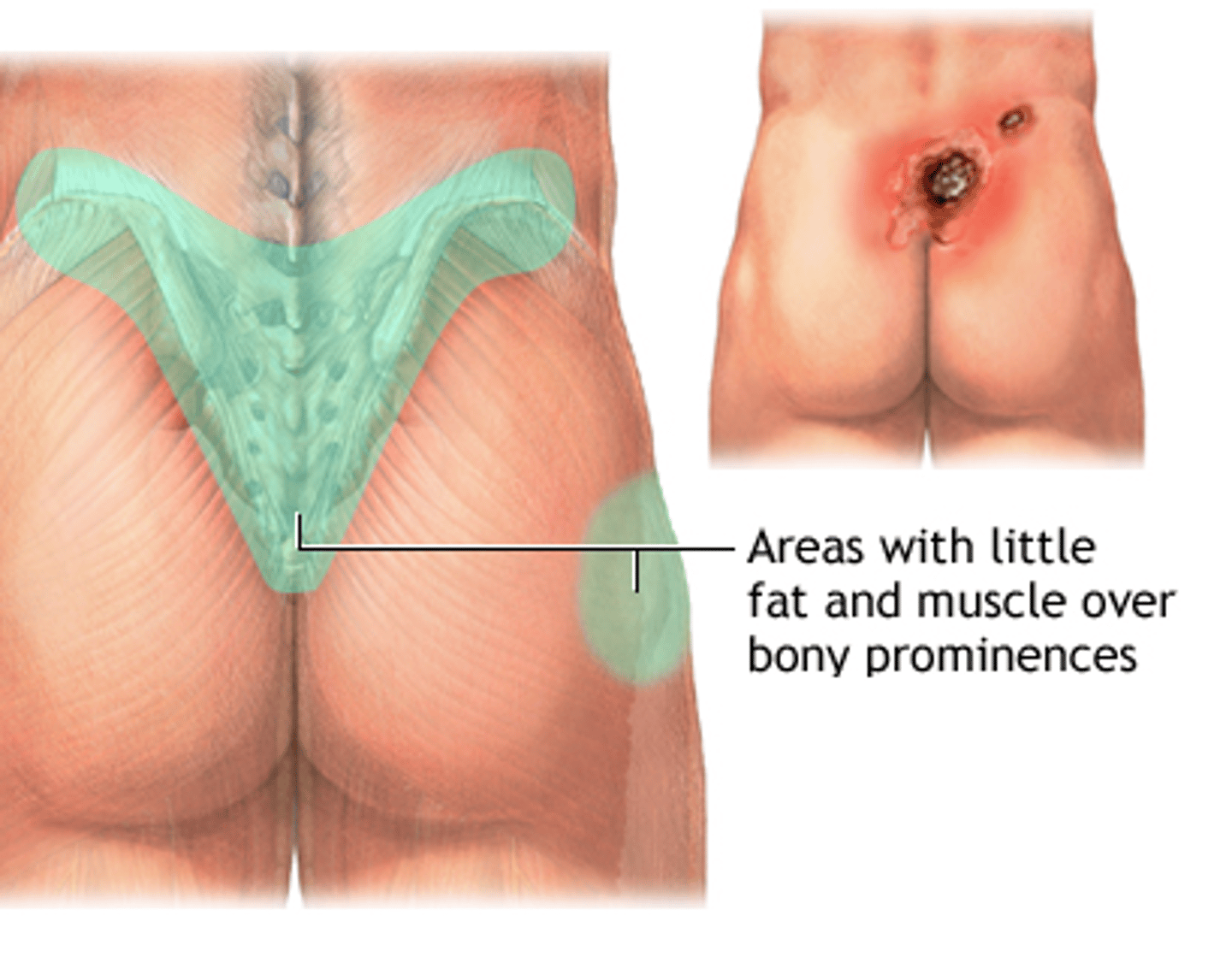 <p>Also called pressure ulcers and decubitus ulcers; Are injuries to skin and underlying tissue resulting from prolonged pressure on the skin. Often develop on skin that covers bony areas of the body, such as the heels, ankles, hips and tailbone.</p>