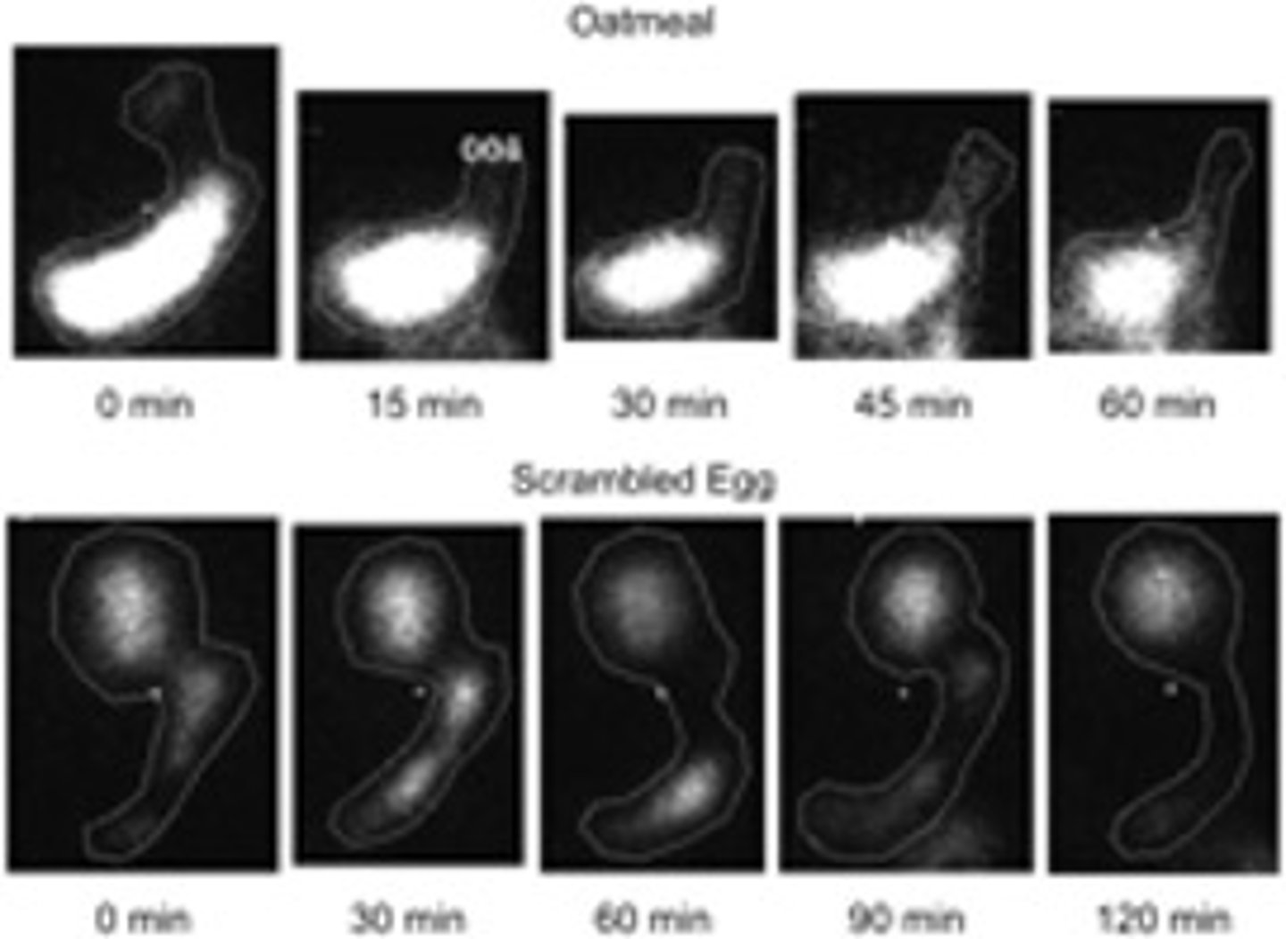 <p>Suspected delayed gastric emptying</p><p>-Radioactive labeled food (eggs)</p><p>-Delayed if &gt; 50% of food remains in stomach after 2 hours</p>