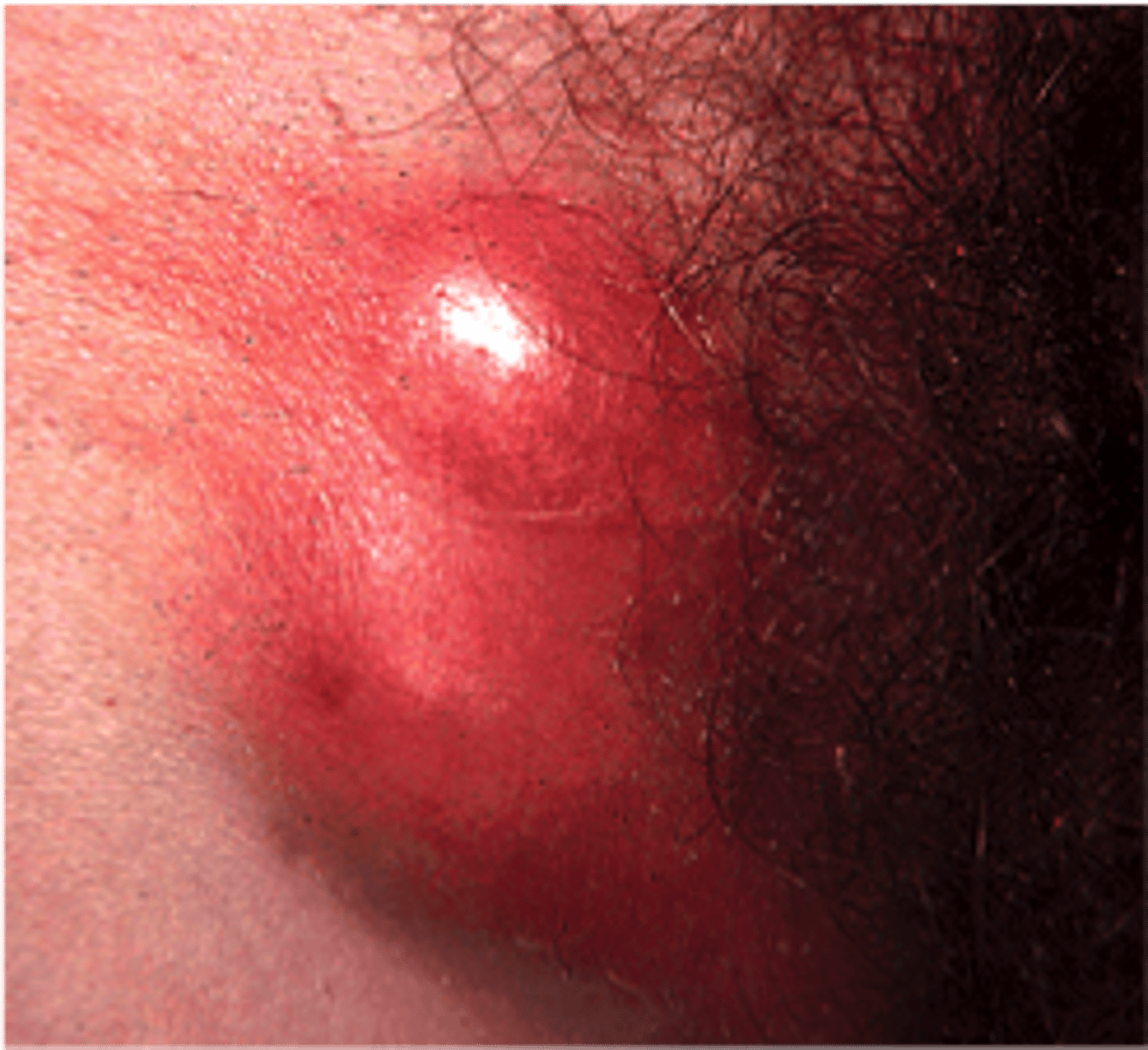 <p>Sexually transmitted infections of inguinal lymphatic channels caused by L serotypes of gram-negative bacteria, Chlamydia trachomatis</p><p>Rare in the US</p><p>M > F</p>