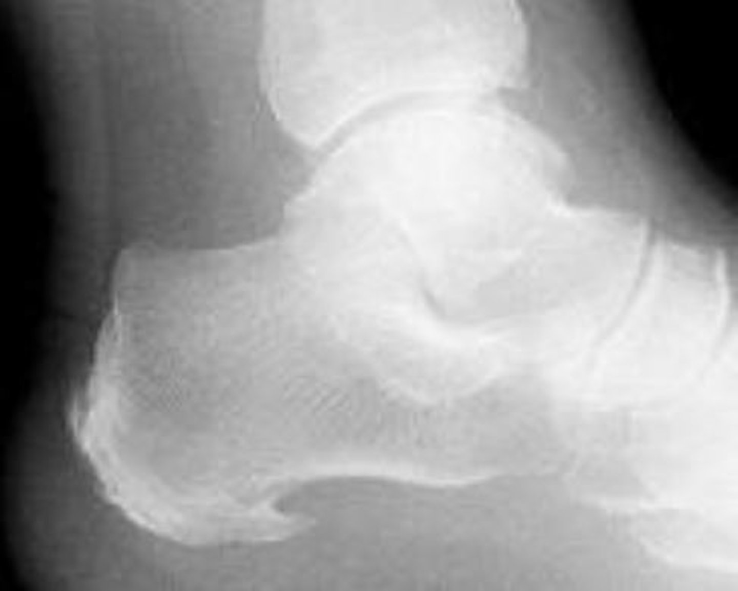 <p>"heel spur"</p>
