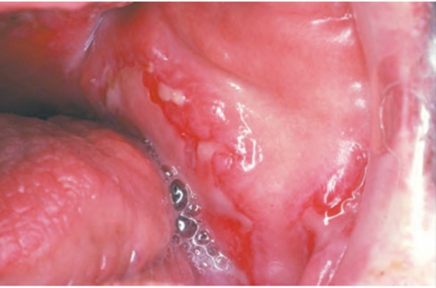 <p>Hint: Most common collagen vascular immune mediated condition in the US; oral manifestations may appear as lichenoid areas</p>
