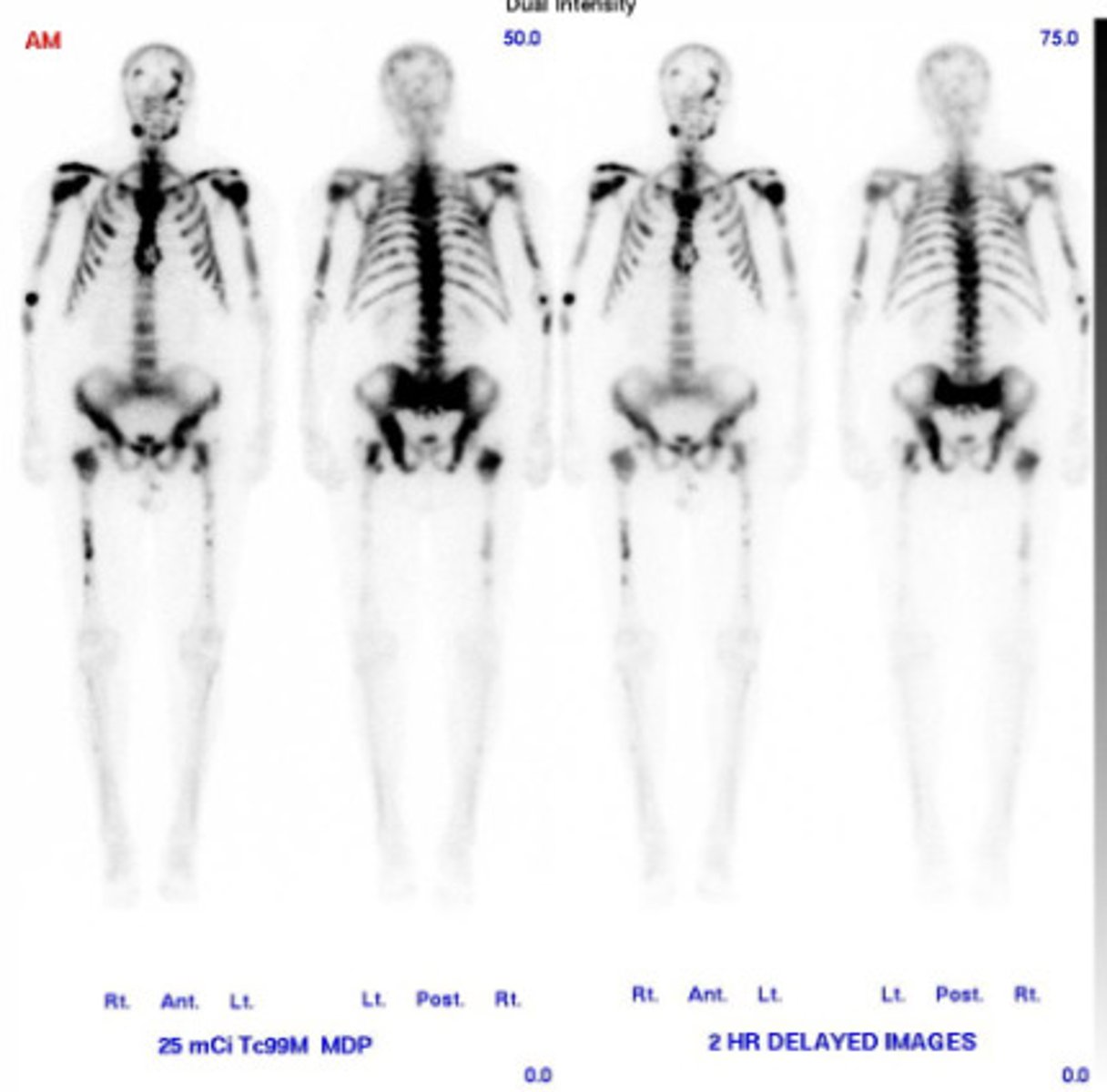 <p>Patients are injected with radioactive material that is then enriched in areas of highest activity.</p>