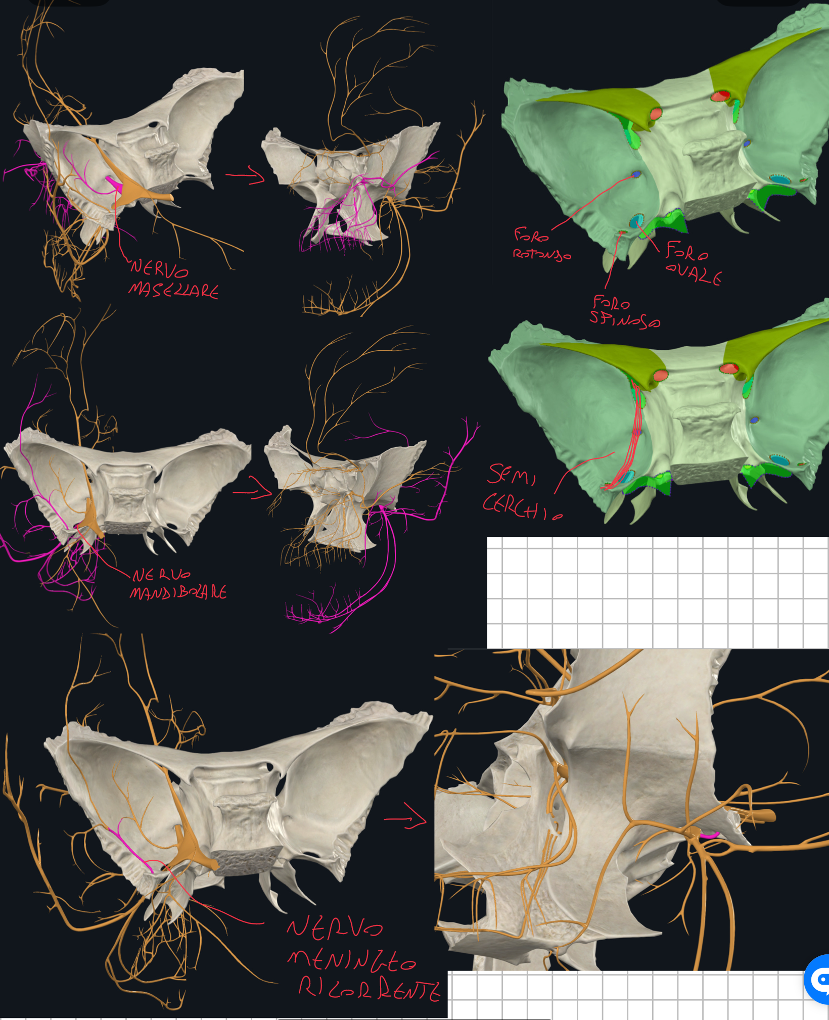 <p>FORO ROTONDO:</p><ol><li><p>Si apre nella Fossa Pterigopalatina</p></li><li><p>E’ attraversato dal Nervo mascellare (seconda branca del trigemino, V2)</p></li><li><p>Le sue ramificazioni sensitive si distribuiscono verso strutture del viscerocranio. Fuori di esso innervano strutture della faccia, e strutture extracraniche nella cavità orbitaria.</p></li></ol><p>FORO OVALE:</p><ol><li><p>Si apre nella Fossa Infratemporale</p></li><li><p>E’ attraversato dal Nervo mandibolare (terza branca del trigemino, V3)</p></li><li><p>Conduce sia fibre sensitive (cute mandibolare, lingua, denti inferiori) che motorie per i muscoli della masticazione</p></li></ol><p>FORO SPINOSO:</p><ol><li><p>Più posterolateralmente rispetto il foro rotondo</p></li><li><p>E’ attraversato dal Nervo Meningeo Ricorrente (nervo spinoso, ramo del V3, che innerva la dura madre) </p></li><li><p>Inoltre, è attraversato dall’Arteria Meningea Media (ramo dell’arteria mascellare, cioè della carotide esterna) che entrando nel cranio attraverso questo foro, invia rami che decorrono lungo la superficie interna delle ossa craniche, in particolare nella zona dello pterion.</p></li><li><p>Raramente, attraverso questo foro può passare anche il Nervo piccolo vetroso (normalmente passa dall’ovale o lacero)</p></li></ol><p></p><p>N.B. I rami del Trigemino:</p><p>V1 → ramo oftalmico → attraversa la fossa orbitaria superiore</p><p>V2 → ramo mascellare → attraversa il foro rotondo</p><p>V3 → ramo mandibolare → attraversa il foro ovale</p><p></p><p>Tutti questi orifizi sono allineati lungo il margine mediale della grande ala dello sfenoide:</p><ul><li><p>Prima la fessura orbitaria superiore</p></li><li><p>Poi il foro rotondo con più dietro quello ovale</p></li><li><p>Infine quello spinoso</p></li></ul><p>Allineati, formano un semicerchio.</p><p></p><p>Il mal di testa è tipico di irritazioni del trigemino.</p><p></p>