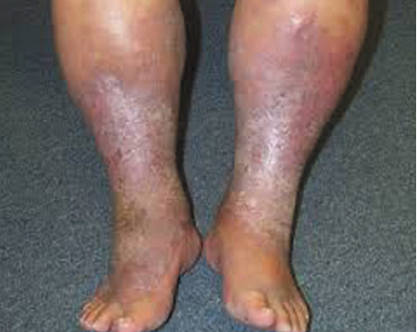 <p>Which condition is most likely cause of patient's symptoms seen in this image? </p>