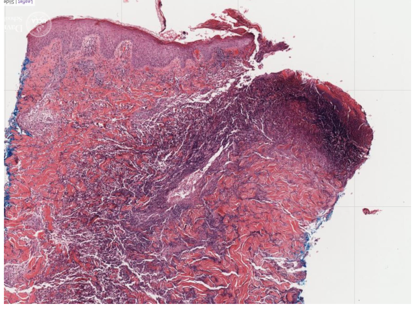 <p>Is the dermal/epidermal junction intact?</p>
