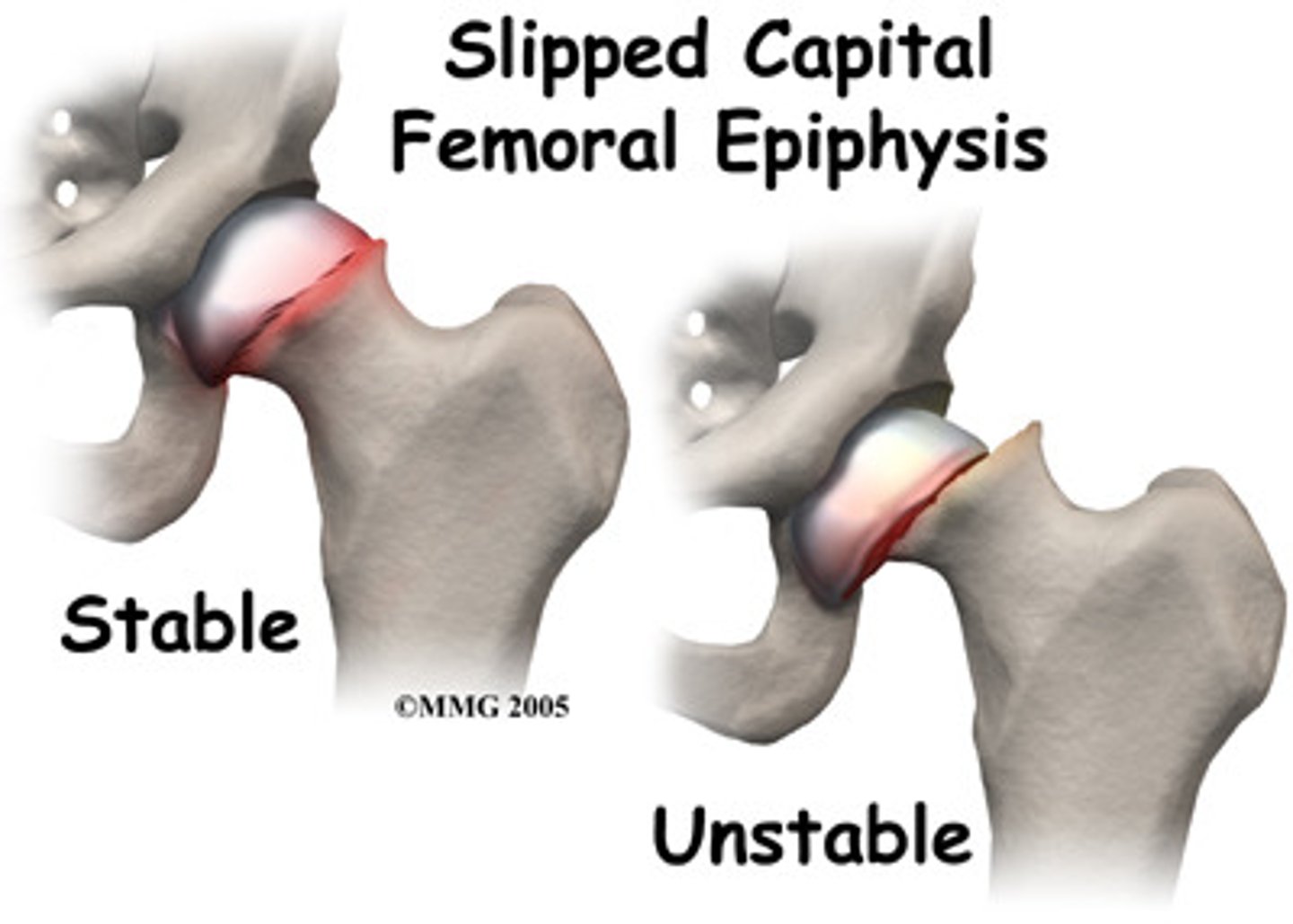 <p>SCFE ***→ displacement of femoral head from neck</p><p>also see:</p><p>LE externally rotated</p><p>shortening of limb</p><p>antalgic gait with abductor lurch</p>