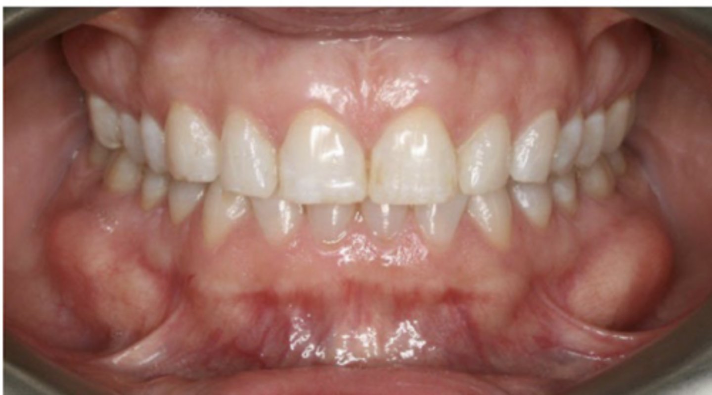 <p>cortical plate</p>