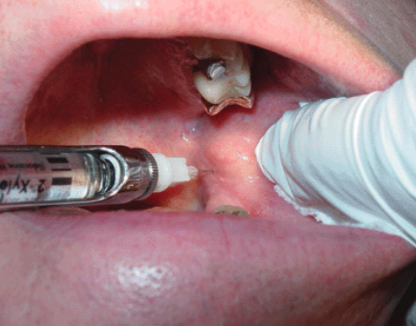 <p>2/3-3/4 the length of a long needle</p>