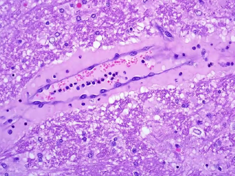 <p>What toxin of Clostridium perfringens is the cause?</p><p>A-Alpha</p><p>B-Beta</p><p>C-Epsilon</p><p>D-Enterotoxin</p>