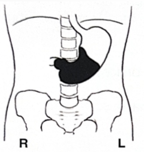<p>White is barium: what position is the patient in? </p>