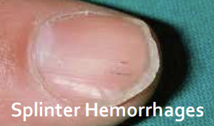 <p>Splinter hemorrhages: distal ends of nails, multiple</p>