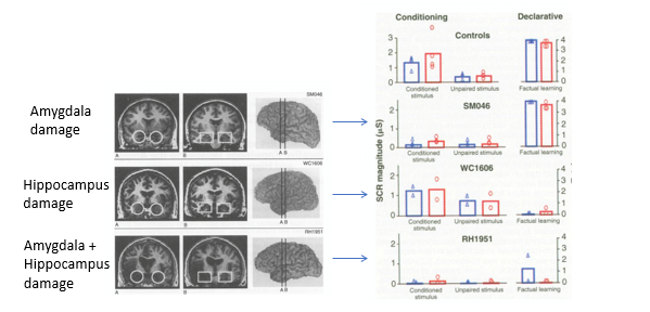 <ul><li><p>studied 3 p – 1 w/amygdala lesion, 1 w/hippocampal lesion, 1 w/damage to both</p></li><li><p>Conditioned Stimulus (CS): coloured slide/tone</p></li><li><p>Unconditioned Stimulus (US): Boat horn</p></li><li><p>Measured Skin Conductance Response (SCR)</p></li><li><p>asked P to report explicit knowledge of which CS predicted the US → conscious knowledge </p></li><li><p>Measured SCR to loud noises paired with a visual or auditory conditioned stimulus</p></li><li><p>double dissociation of conditioning &amp; declarative knowledge relative to amygdala &amp; hippocampus</p><ul><li><p>P w/amygdala damage showed impaired SCR to the conditioned stimulus but intact factual learning</p><ul><li><p>little skin conductance response </p></li><li><p>can consciously identify </p></li></ul></li><li><p>P w/hippocampus damage showed normal SCR to the conditioned stimulus but impaired factual learning</p><ul><li><p>normal SCR</p></li></ul></li><li><p>P w/both amygdala &amp; hippocampus damage showed impaired SCR to conditioned stimulus and impaired factual learning</p></li></ul></li><li><p><strong>Amygdala is necessary for implicit learning of threat</strong></p></li><li><p><strong>hippocampus is involved in declaritive learning </strong></p></li></ul><p></p>