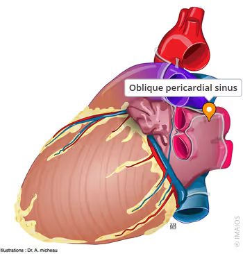 <p>Xoang chếch ngoại tâm mạc (Pericardial sinus)</p>