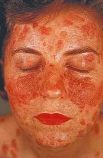 <ul><li><p>Identify the disease</p></li><li><p>Oral manifestation</p></li><li><p>Histologic feature</p></li><li><p>Differential diagnosis</p></li><li><p>Treatment</p></li><li><p>Products that can be used to relieve pain</p></li></ul><p></p>