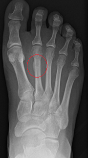 <p>What fracture is this? </p>