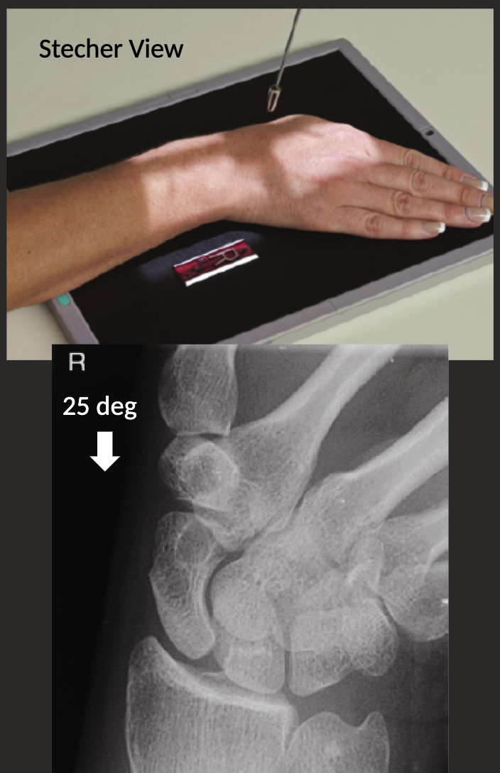 <ul><li><p>PA wrist with ulnar deviation.</p></li><li><p>Centre to anatomical snuffbox.</p></li></ul><p></p><p>PA axial with ulnar deviation: Stecher view.</p><ul><li><p>Position as above, but with cephalic angle of 15-30 degrees.</p></li></ul><p></p>