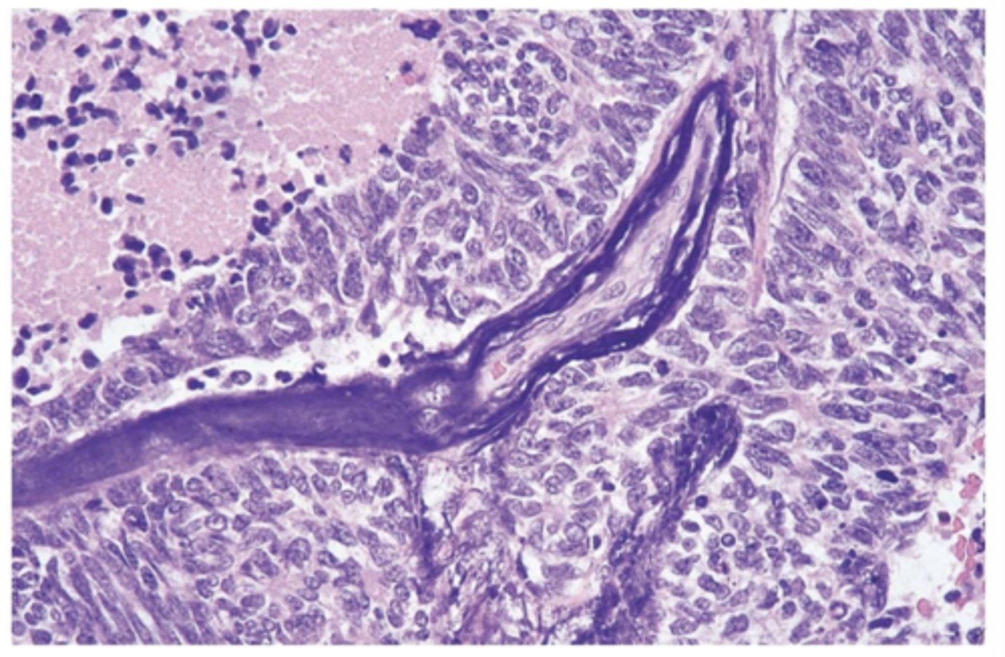 <p>small cell lung carcinoma</p><p>*metastasis usually present at diagnosis</p>