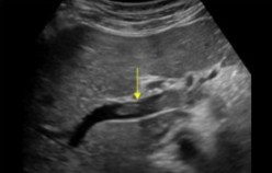 <ol><li><p>What structure is seen here?</p></li><li><p>What pathology is seen within it?</p></li></ol><p></p>