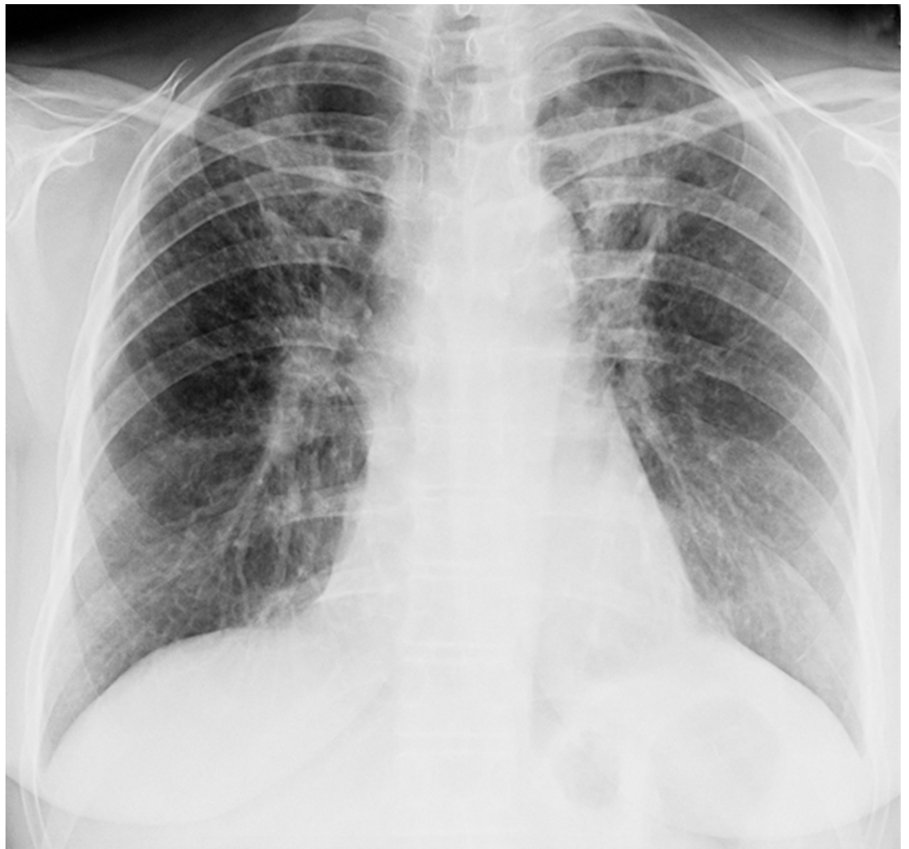 <p>What are you going to see in a CXR that give off the vibes of sarcoidosis?</p>