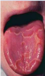 <p>Un tipo normal de lengua, se forma por pérdida de papilas</p>