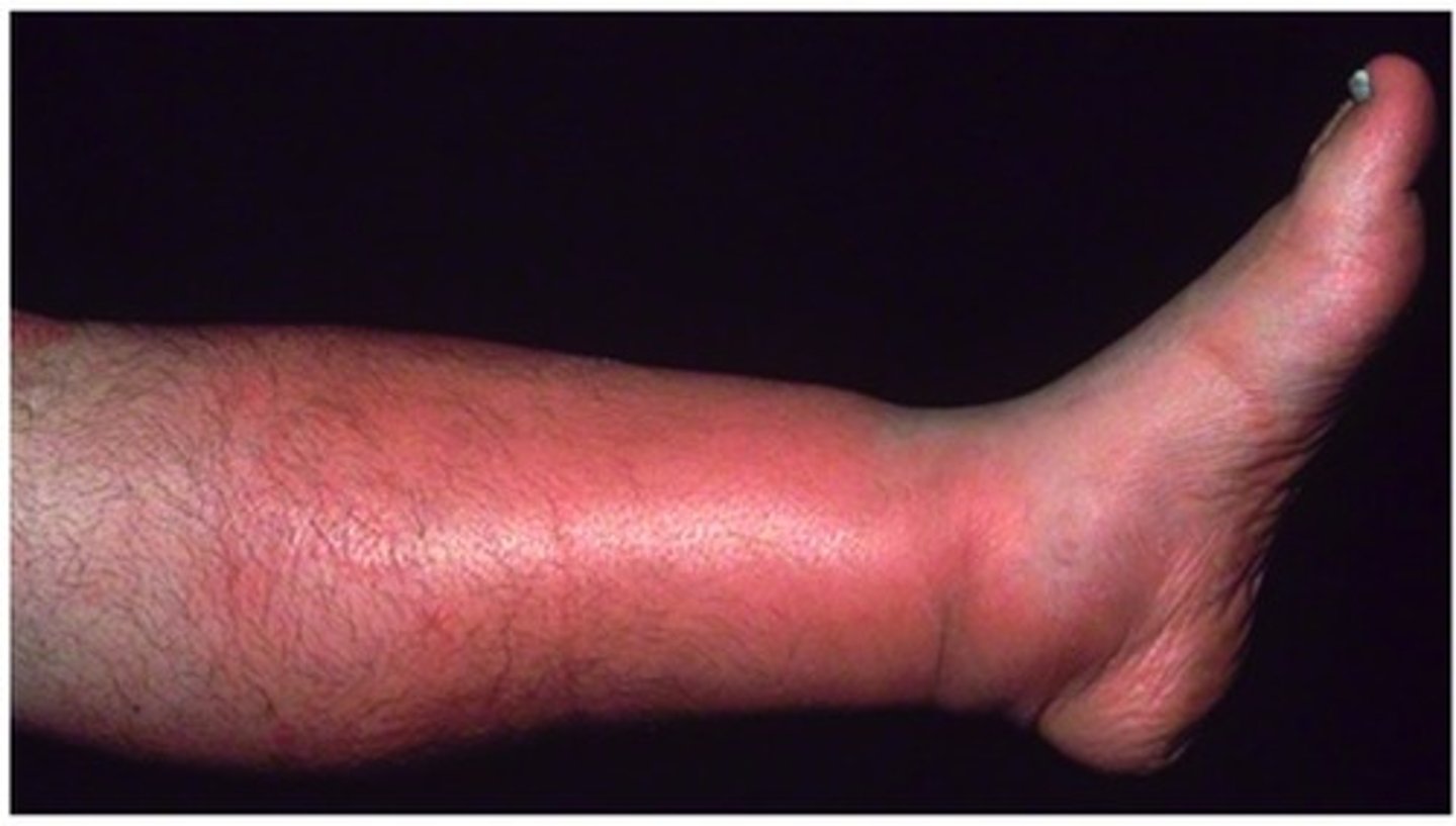 <p>Risk Factors</p><p>-DM</p><p>Sx</p><p>-Skin warmth + erythema (Strep Pyogenes)</p><p>-Painful erythema (Staph Aureus)</p>