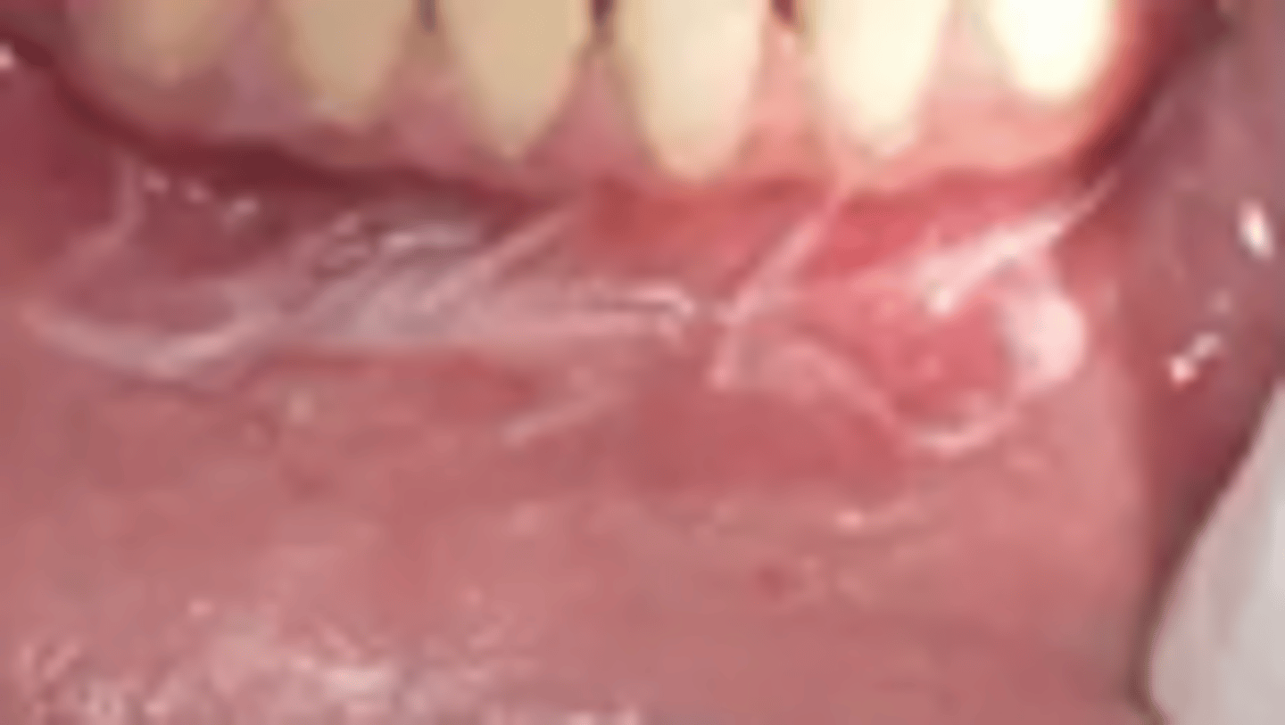 <p>translucent-whitish film that removes with gentle pressure </p><p>• string-like</p><p>• type of mucositis</p>