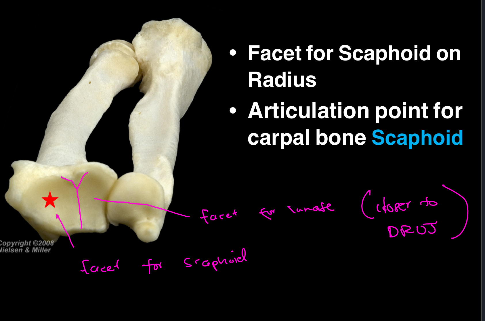 <p>The facet for scaphoid and the facet for lunate. A good way to remember them is that the facet for lunate is closer to the head of the ulna. BOTH facets are located on the radius. </p>
