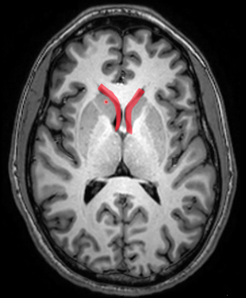 <p>anterior to interventricular foramen</p><p>no choroid plexus</p><p>lateral wall: caudate nucleus</p>