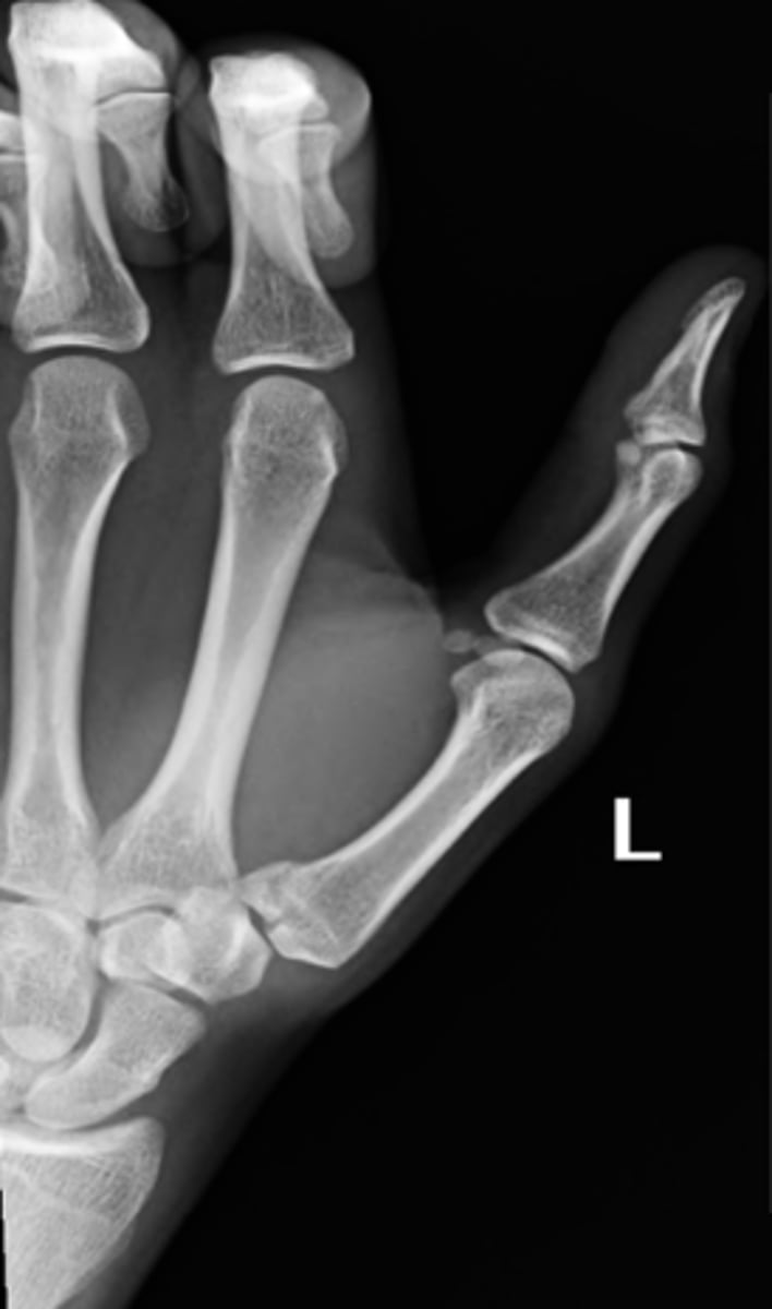 <p>Fx of the proximal end of the first metacarpal</p>