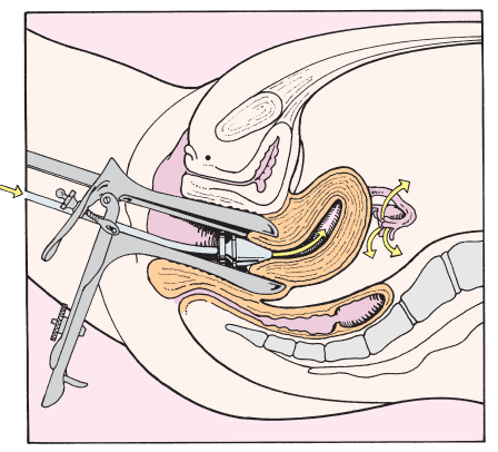 <p>Useful for identification of tubal obstruction and for the release of blockage</p><p>Contrast medium flows through the intrauterine cannula and out through the uterine tubes.</p>