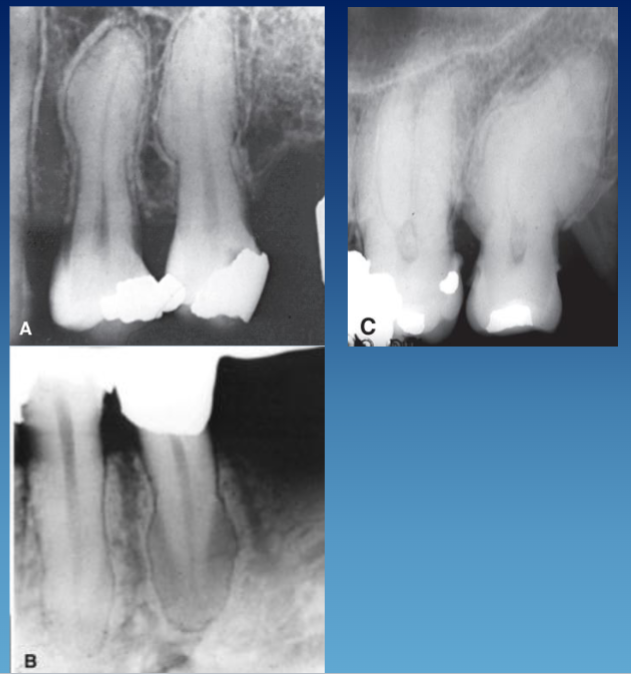 <ul><li><p>within PDL space </p></li><li><p>bulbous root </p></li><li><p>lamina dura and PDL in tact </p></li><li><p>well defined </p></li></ul><p></p>