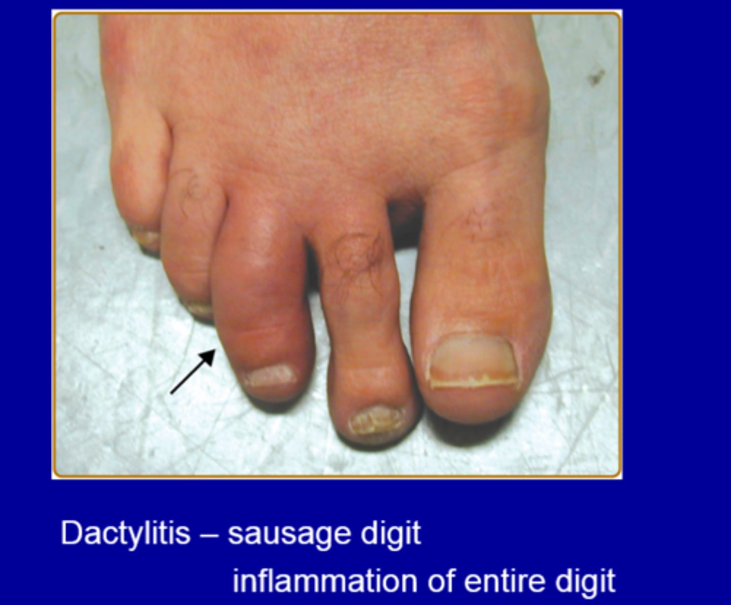 <p>dactylitis</p>