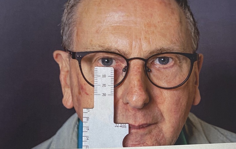 <p>The patient should be fitted with the frame to be glazed, correctly adjusted. The scale on the back surface of the projecting portion of the gauge is placed vertically in front of the eye so that the top edge is level with the required vertical segment position. The scale is read downwards to the lower horizontal tangent to the lens.</p>