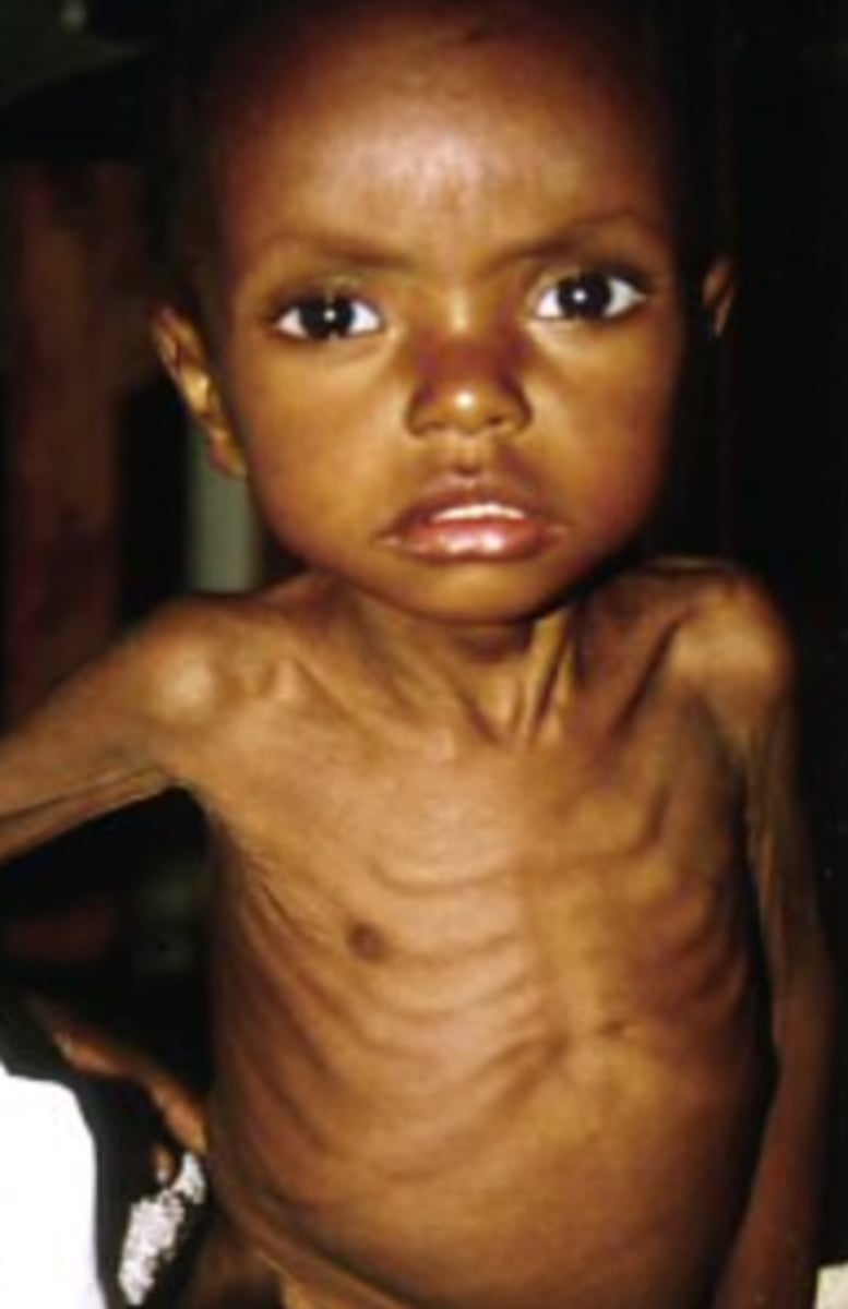 <p>physical weakness and bad health caused by having too little food: suy dinh dưỡng</p><p>ex: Many of the refugees are suffering from severe malnutrition.</p>