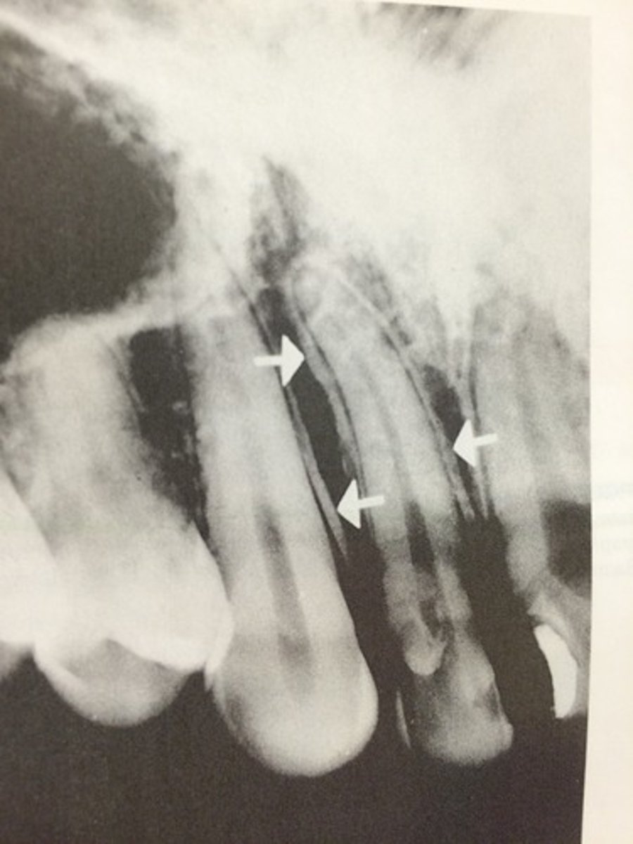 <p>Loss of lamina dura</p>